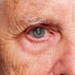 Olhos com catarata aumentam a chance de quedas