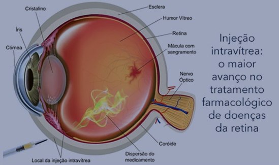 Aplicação-Intravítrea-de-Anti-angiogênicos-em-Vitória-ES