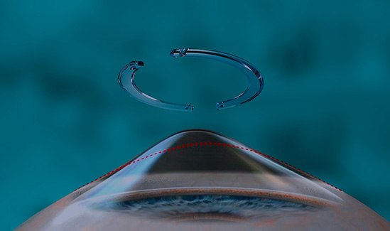 Implante do Anel Intraestromal-oftalmologista-Vitoria-ES