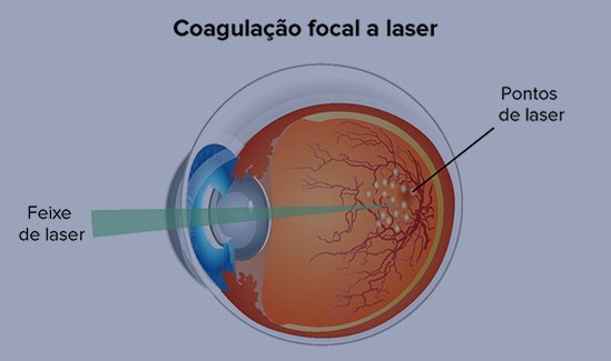 Fotocoagulação a Laser