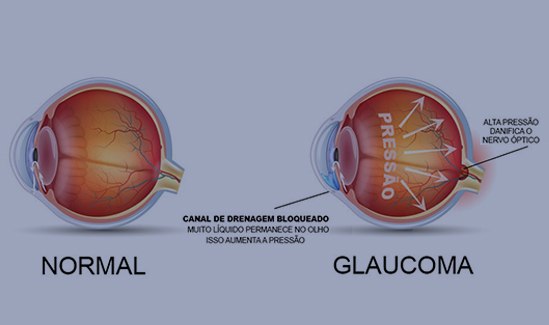 Tratamento-do-Glaucoma-em-Vitória-ES