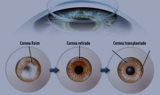 Transplante-de-cornea-oftalmologista-Vitoria-ES